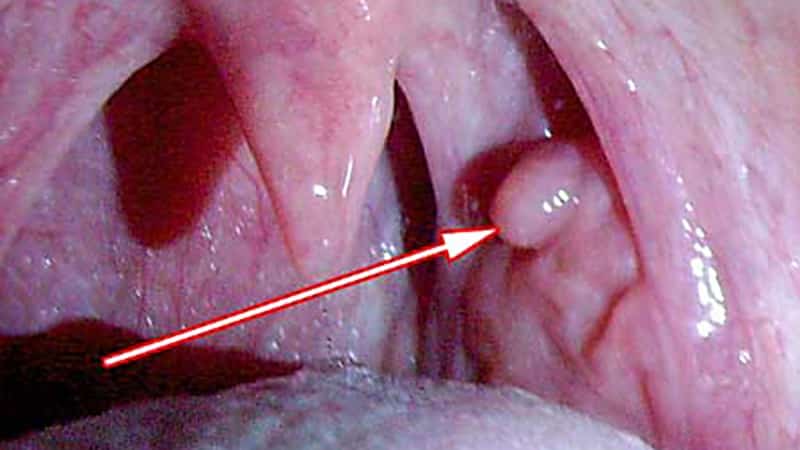 шишка на внутренней стороне щеки