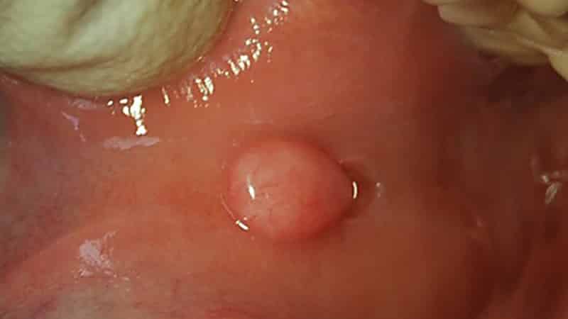 шишка внутри щеки