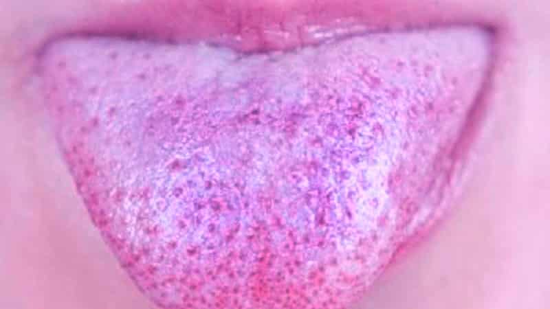 Синий налет на языке