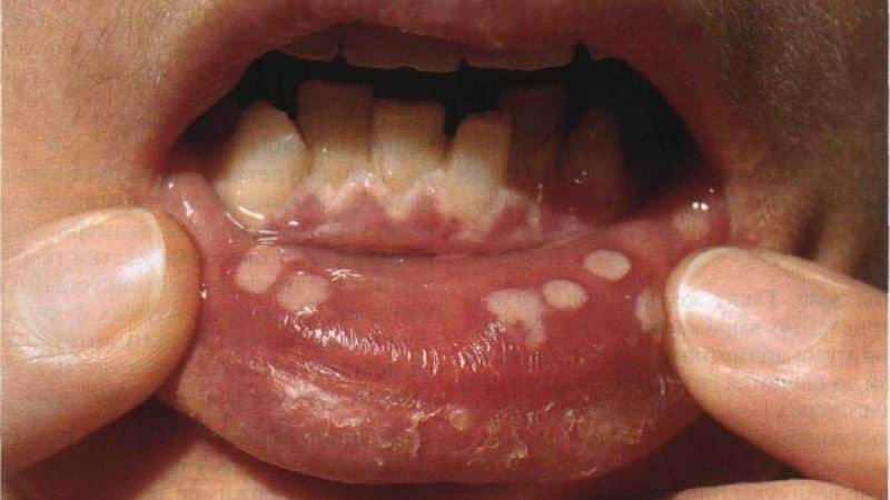 как долго проходит стоматит у детей