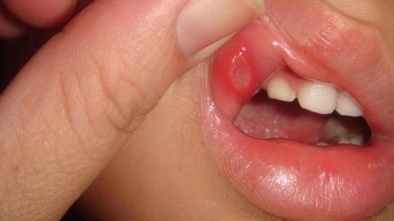 через сколько дней проходит стоматит у ребенка