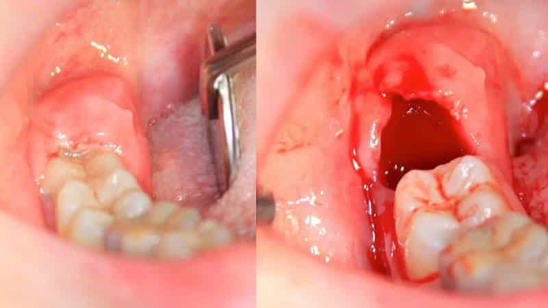 сколько дней болит десна после удаления зуба времени