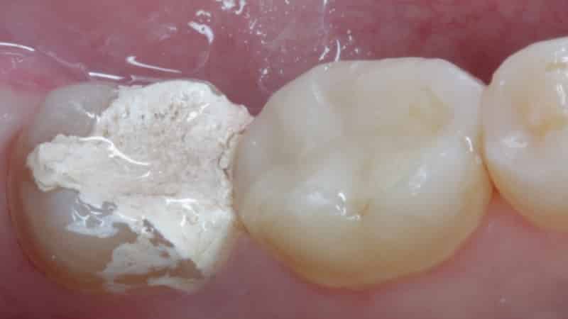 сколько можно ходить с мышьяком в зубе временная пломба