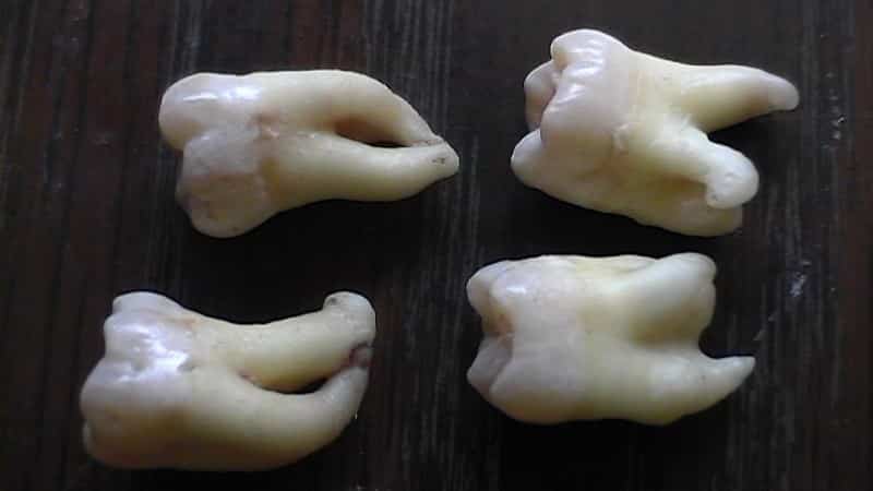 сколько нервов в коренном зубе