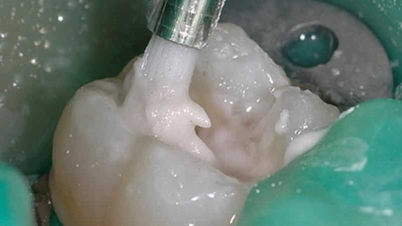 когда можно есть после пломбирования зуба