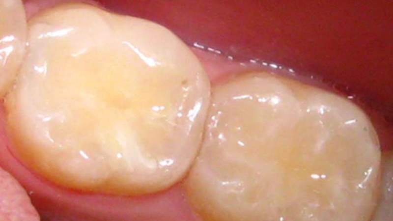 сколько нельзя есть после пломбы