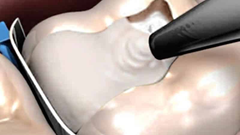 можно ли курить после пломбирования зуба