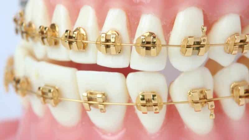 надо носить брекеты