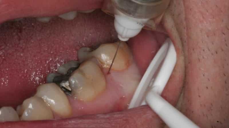 действует анестезия на зуб