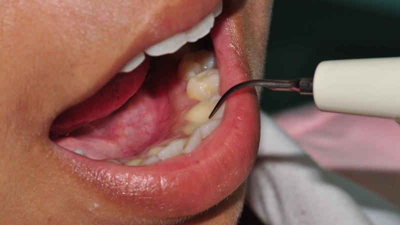 удаление зубных отложений ультразвуком