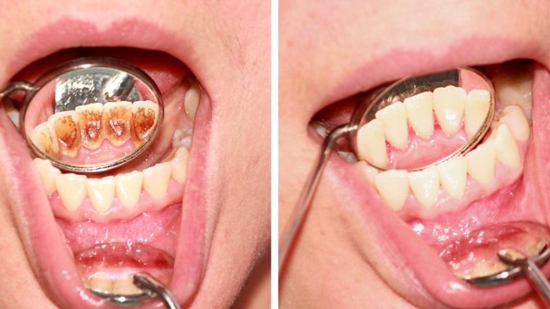До и после удаления зубного камня