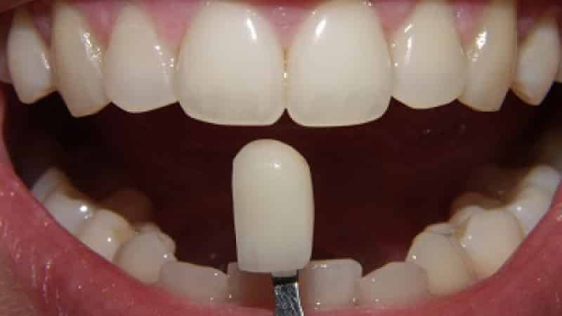 современные несъемные зубные протезы нового поколения