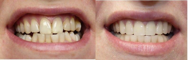 Световая пломба на передних зубах