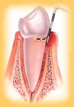 Болезнь десен гингивит Болезнь десен гингивит