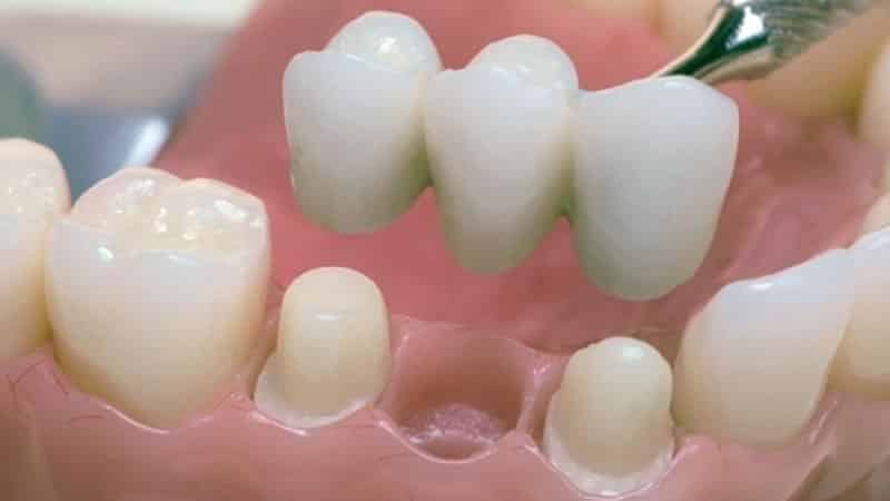 пластмассовые зубные протезы отзывы