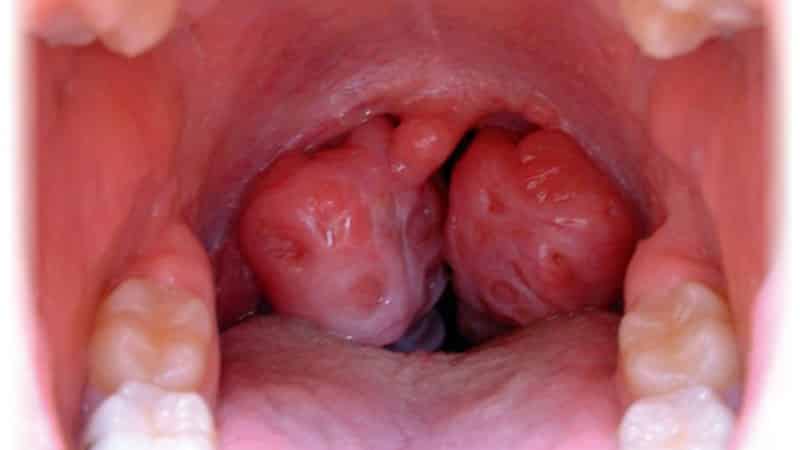 нужно ли удалять гланды при хроническом тонзиллите