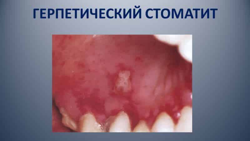 кровоточат десны у ребенка