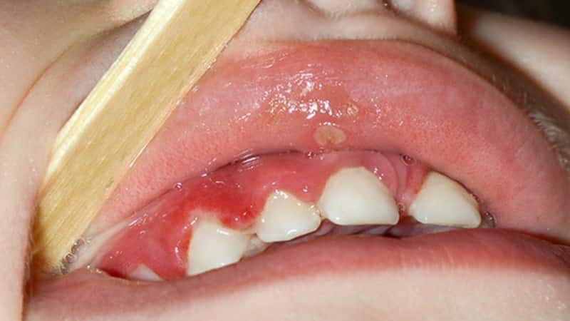 у ребенка кровят десна