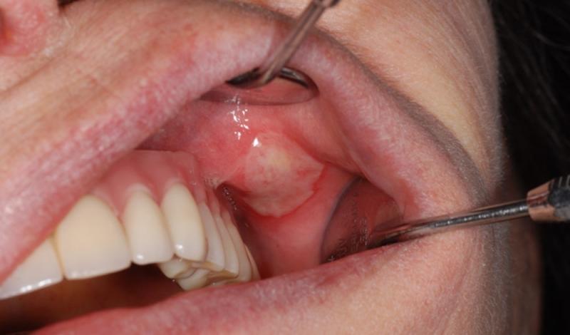стоматит на щеке фото