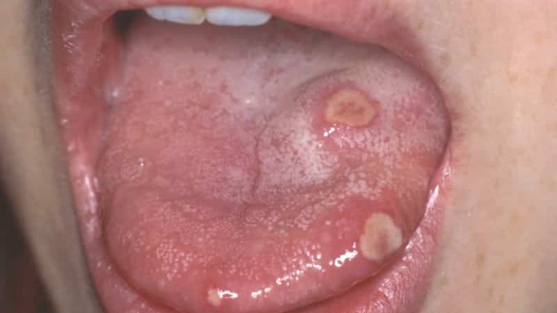 стоматит на языке у ребенка фото