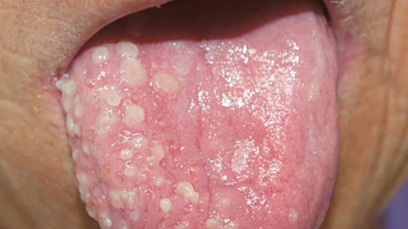 чем и как лечить стоматит на языке у ребенка