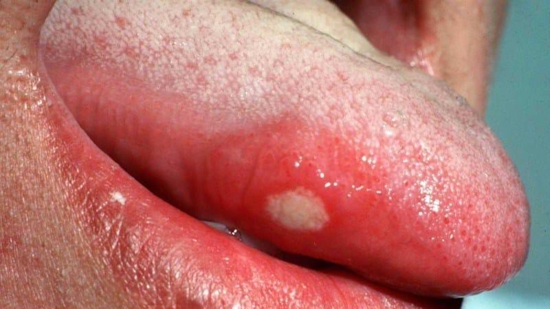 стоматит на языке у детей лечение