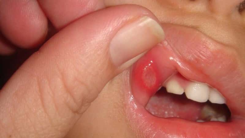 стоматит симптомы