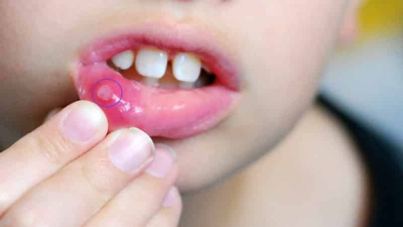 симптомы стоматита