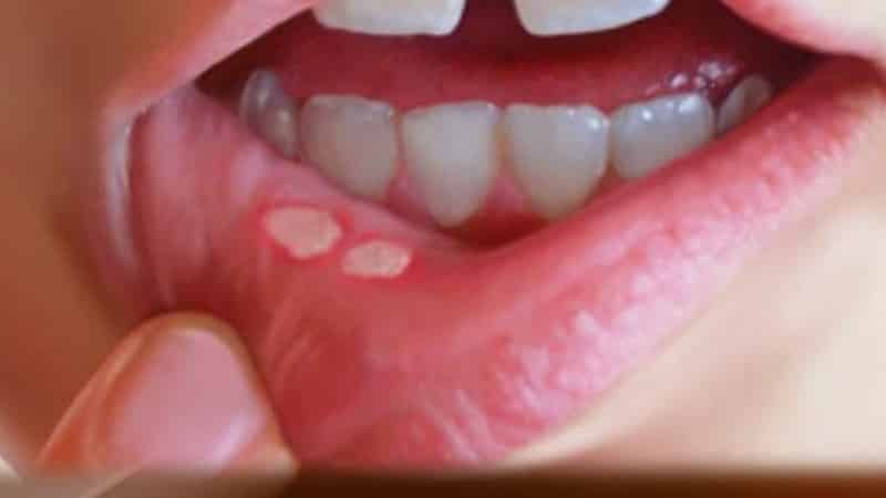 что за болезнь стоматит