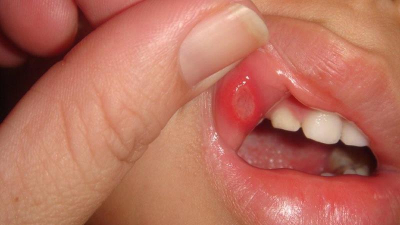 стоматит у детей причины возникновения