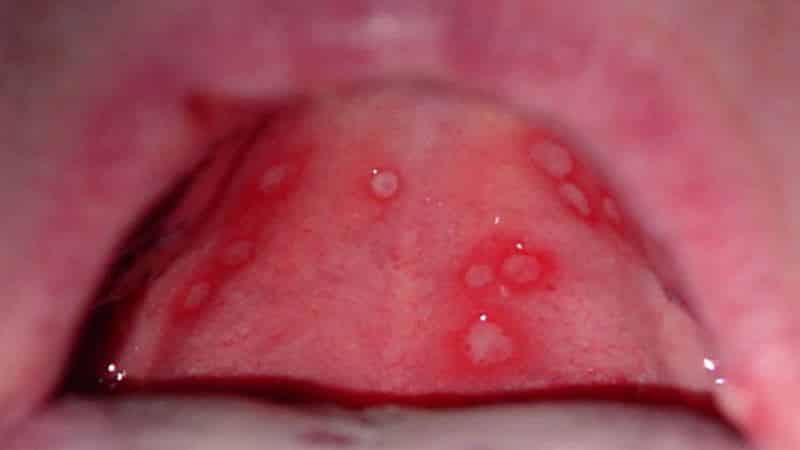 стоматит у детей признаки и лечение