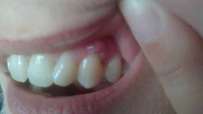 свищ на десне у ребенка фото