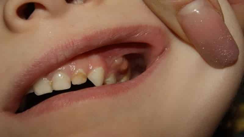 у ребенка свищ на десне что делать