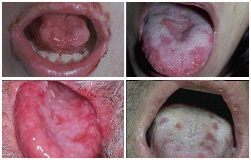 сыпь на языке у ребенка причины