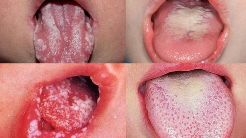 высыпание на языке