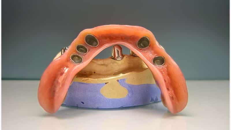 телескопическая коронка это