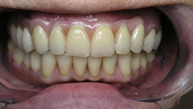 телескопические коронки этапы изготовления фото