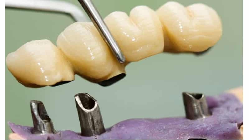 телескопическая коронка с фрикционным штифтом