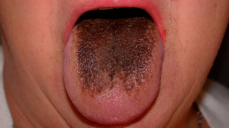 Темный налет на языке