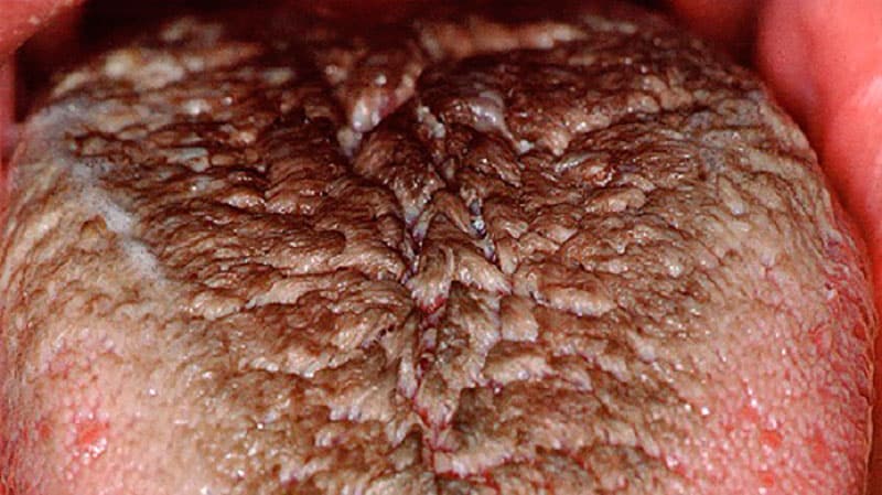 Темный налет на языке