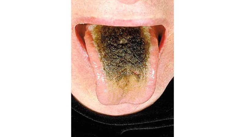 Темный налет на языке