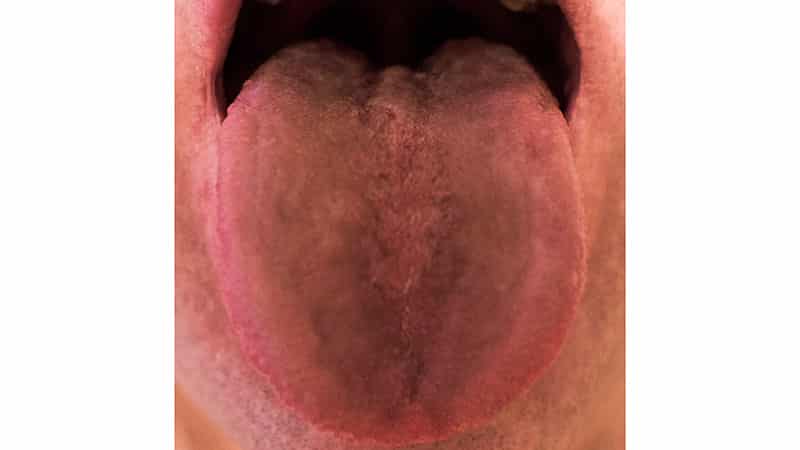 Темный налет на языке