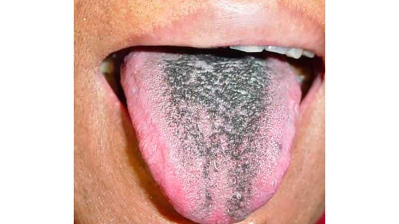 Темный налет на языке