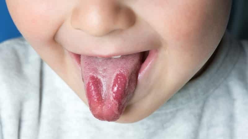 типун на языке лечение