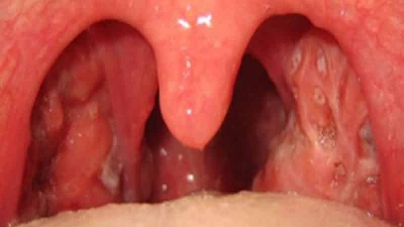 симптомы тонзиллит у детей