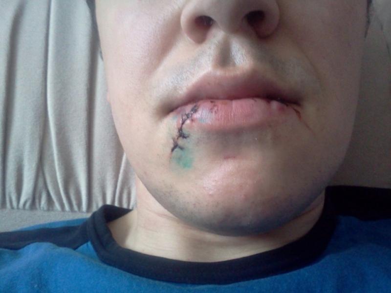 травматический стоматит у взрослых лечение