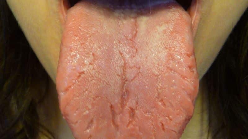 трещины на языке причины и лечение фото