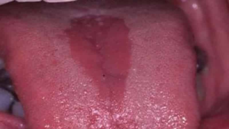 почему язык в трещинах причины