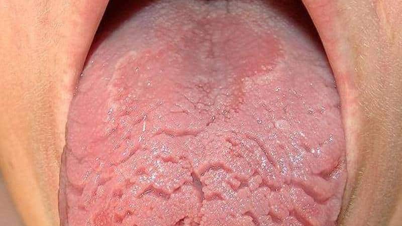 почему на языке появляются трещины