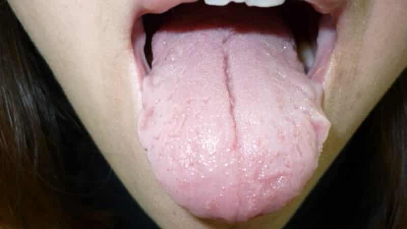 как лечить трещины на языке фото